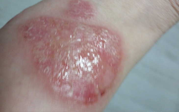 Zbiórka Na walkę łuszczycom - zdjęcie główne