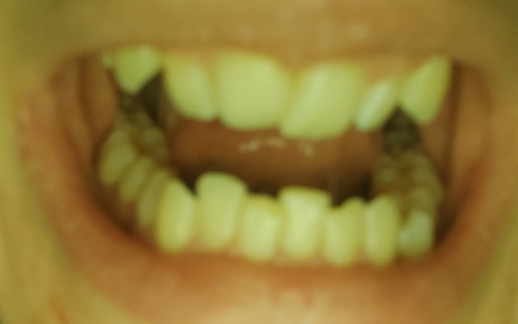 Zbiórka leczenie ortodontyczne aparat na - zdjęcie główne