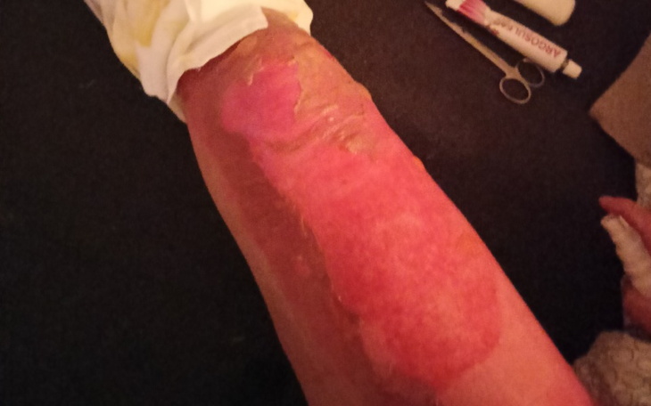 Zbiórka Poparzenia trzeciego stopnia - zdjęcie główne