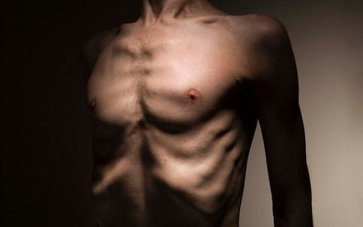 Zbiórka Wygrać z anoreksja - zdjęcie główne