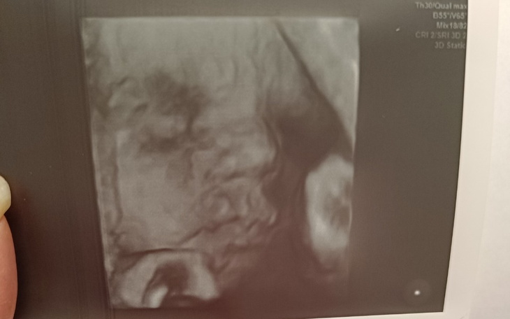 Ultrasonografia, obraz rozwijającego się dziecka.