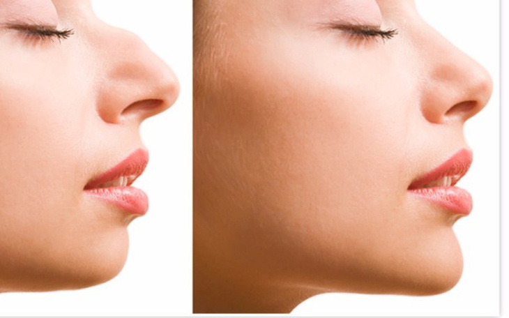 Zbiórka Piękny nowy nos dla mojej żony - zdjęcie główne