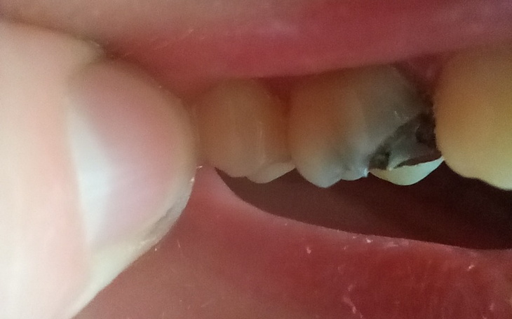 Zbiórka Na nagłe leczenie zęba - zdjęcie główne