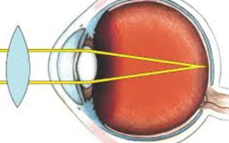 Zbiórka Operacja laserowa oczu - zdjęcie główne