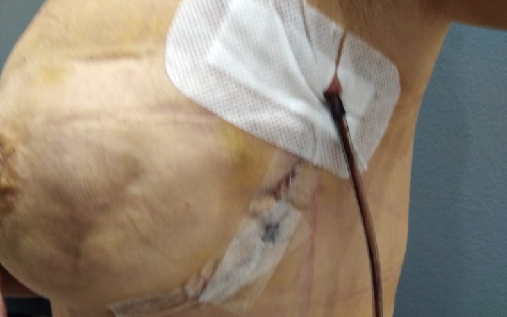 Zbiórka Leczenie onkologiczne Dorotki - zdjęcie główne