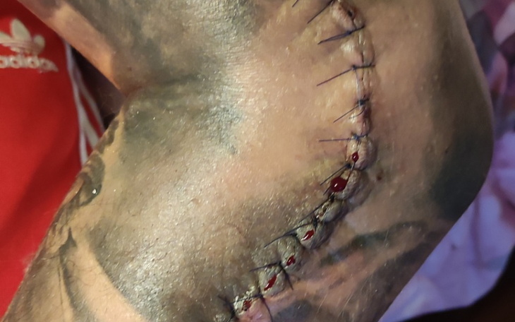 Zbiórka Rehabilitacja łokcia - zdjęcie główne