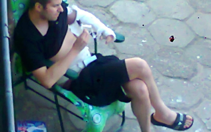 Zbiórka Operacja obojczyka lewego - zdjęcie główne