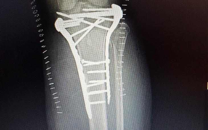 Zbiórka Pomoc dla naszej koleżanki Ani. - zdjęcie główne