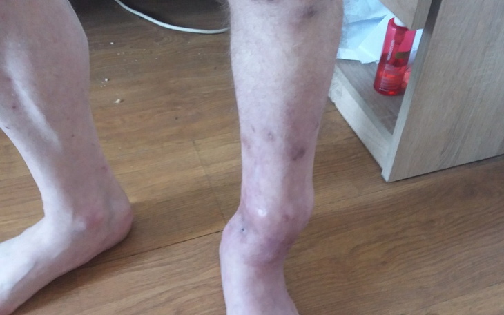 Zbiórka Prosze o pomoc na leczenie nogi - zdjęcie główne