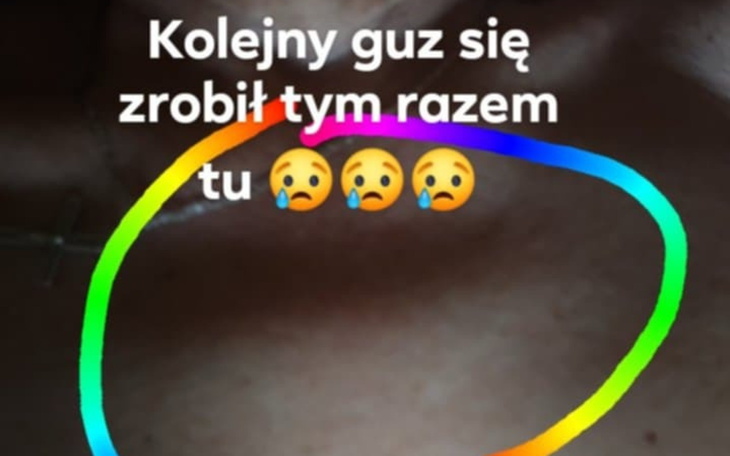 Kolejny guz na ciele, zmartwienie i smutek.
