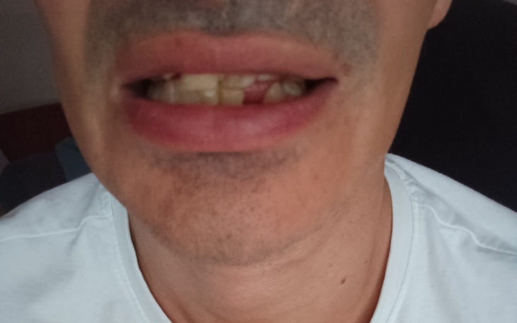 Zbliżenie na usta mężczyzny z brakującymi zębami.