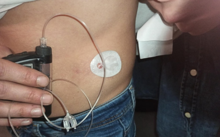 Osoba z urządzeniem medycznym na brzuchu, widok z boku.