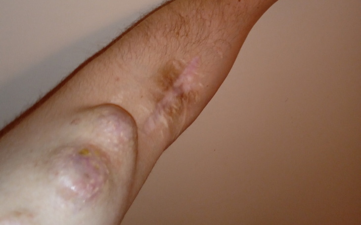 Zbiórka Usunięcie tętniaków żylnych - zdjęcie główne