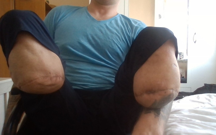 Zbiórka protezy, wuzek - zdjęcie główne