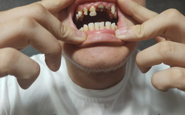 Zbiórka Rekonstrukcja uzębienia - zdjęcie główne