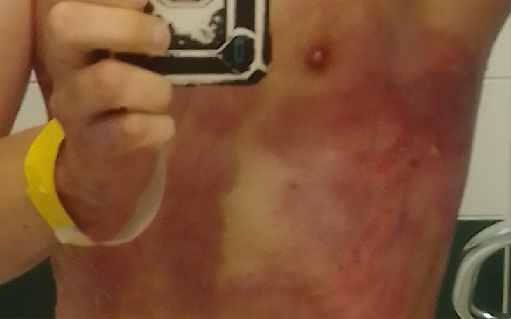 Zbiórka Pomoc po oparzeniu - zdjęcie główne