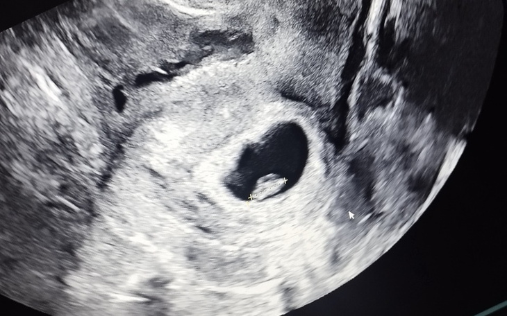 USG pokazujące rozwijający się płód w macicy.