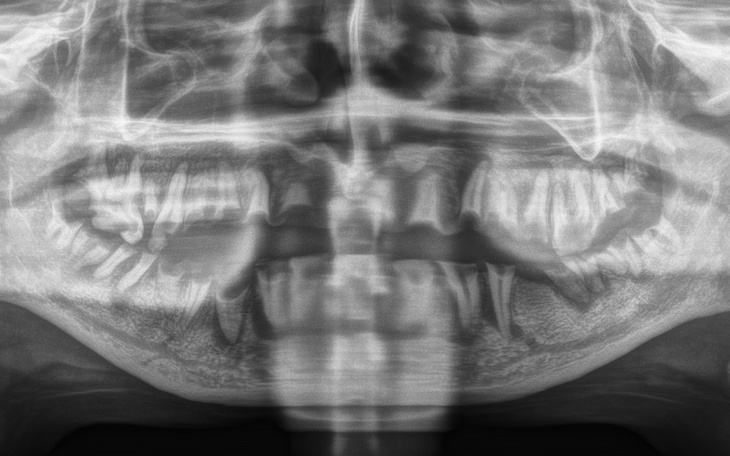 Zdjęcie rentgenowskie zębów.