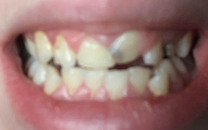 Zbiórka Leczenie i aparat na zęby - zdjęcie główne