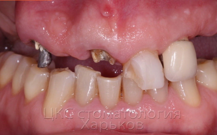 Zdjęcie z bliska przedstawiające uszkodzone zęby.