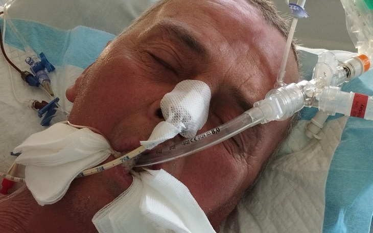 Mężczyzna w szpitalu, z rurkami medycznymi i opatrunkiem na twarzy.