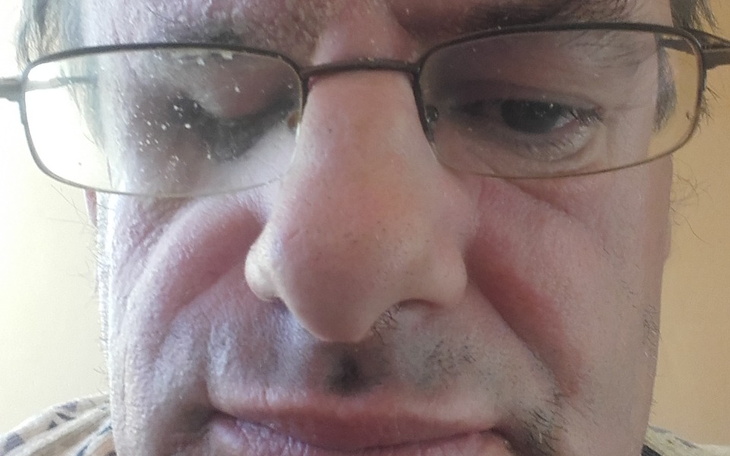 Zbiórka operacja plastyczna oka - zdjęcie główne