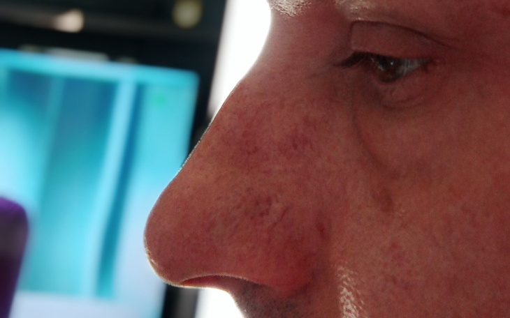 Zbiórka Zabieg Nosa - zdjęcie główne