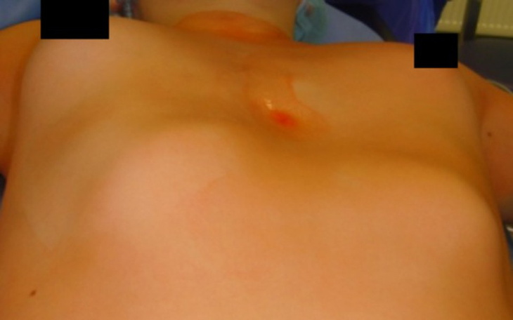 Zbiórka Zdeformowana klatka piersiowa - zdjęcie główne