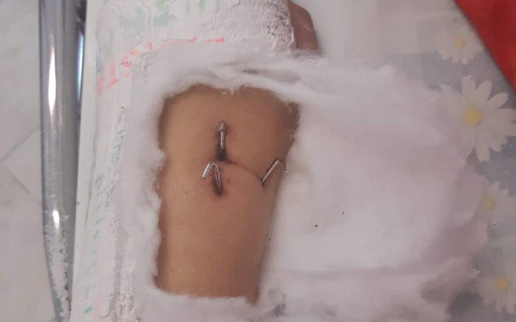 Zbiórka Na rehabilitację nadgarstka - zdjęcie główne