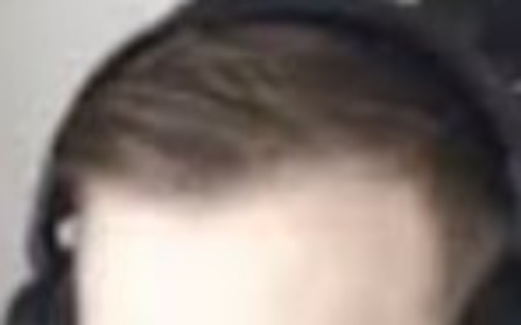 Zbiórka Na przeszczep włosów2 - zdjęcie główne