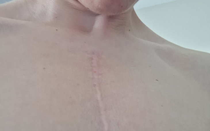 Widok na bliznę na klatce piersiowej, blisko ciała.