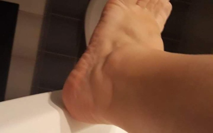 Zbliżenie na stopę z opuchlizną.