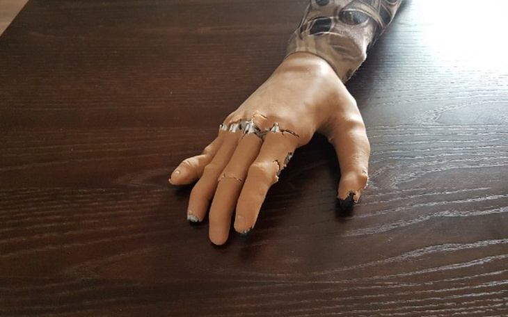 Zbiórka Naprawa protezy bionicznej - zdjęcie główne