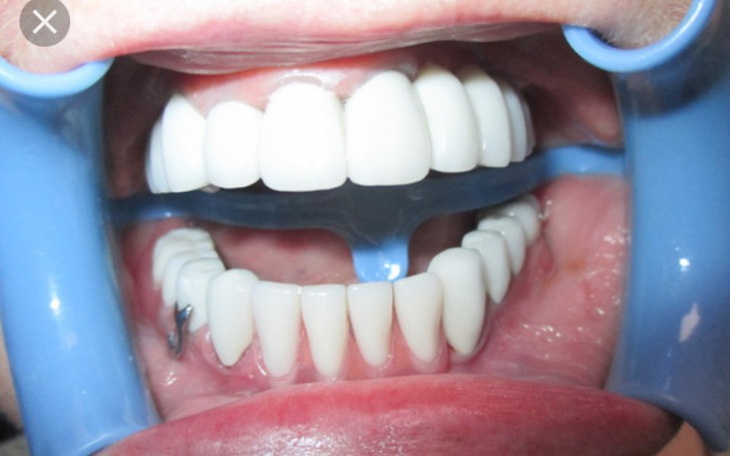 Zbiórka Nowe zęby dla przyjaciółki - zdjęcie główne