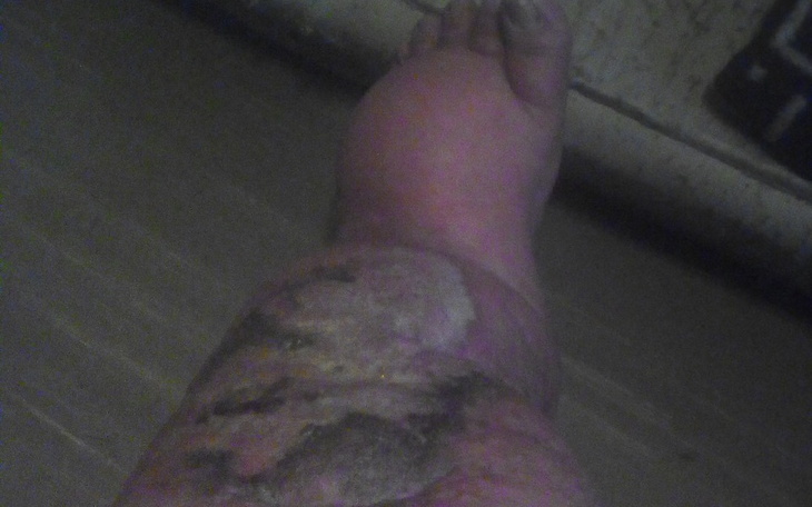 Zbiórka Zator tęcznicz nogi lewej - zdjęcie główne