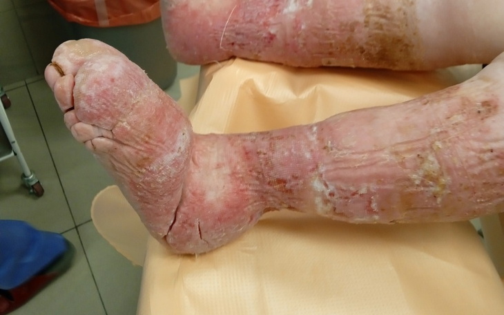 Zraniona noga pacjenta z widocznymi ranami i obrzękiem.