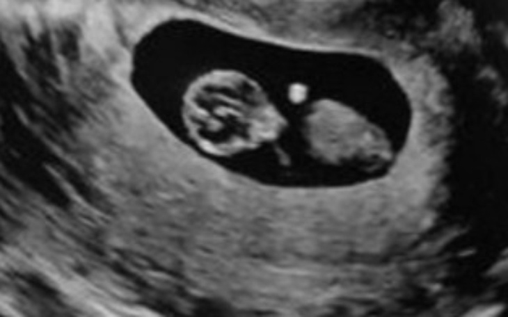 Ultrasonografia pokazująca rozwijający się płód.