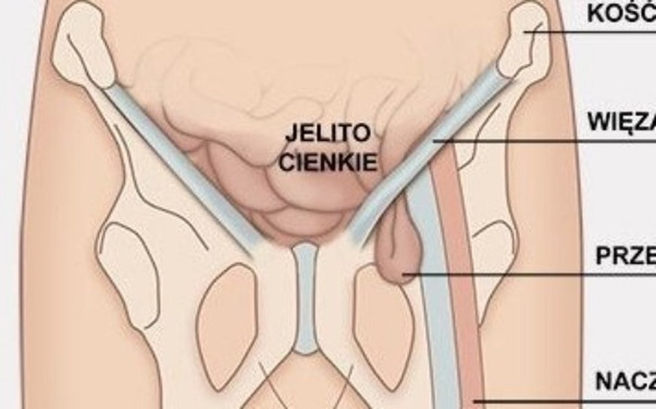 Zbiórka Przepuklina pachwinowa - zdjęcie główne