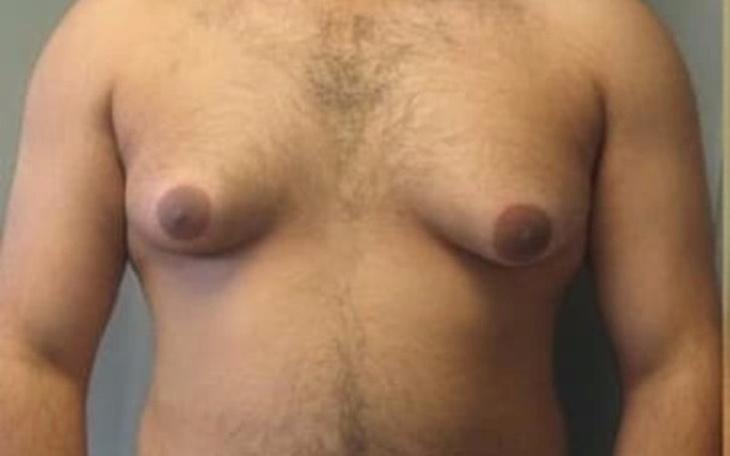 Zbiórka operacja ginekomasti -pomóż - zdjęcie główne