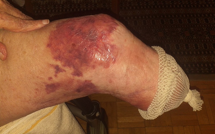 Zbiórka Proteza kończyny dla taty - zdjęcie główne