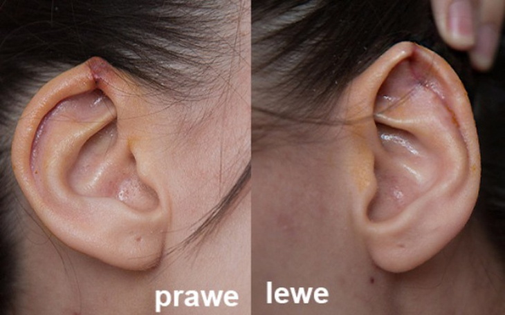 Zbiórka Chirurgia plastyczna - uszy - zdjęcie główne
