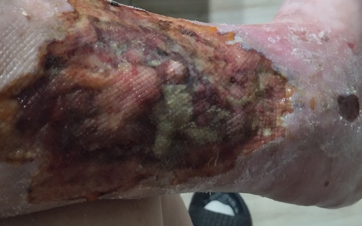 Rana na nodze z widocznymi oznakami gojenia.