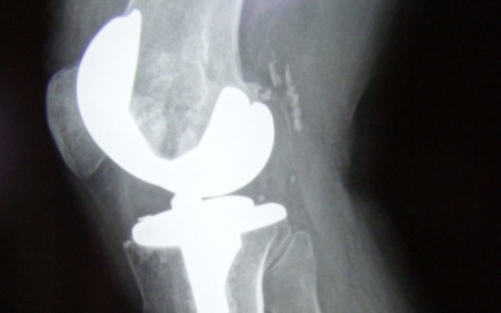 Zbiórka Endoproteza stawu kolanowego - zdjęcie główne