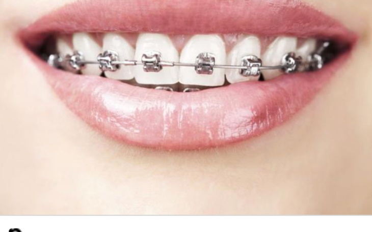 Zbiórka Aparat na zęby dla dziecka - zdjęcie główne