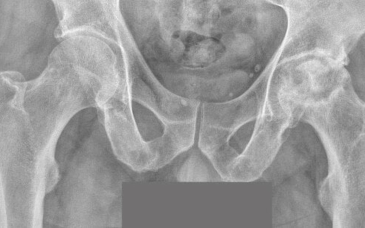 Rentgen miednicy, ukazujący szczegóły anatomiczne.