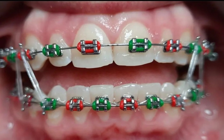 Zbiórka Aparat na zęby0190 - zdjęcie główne