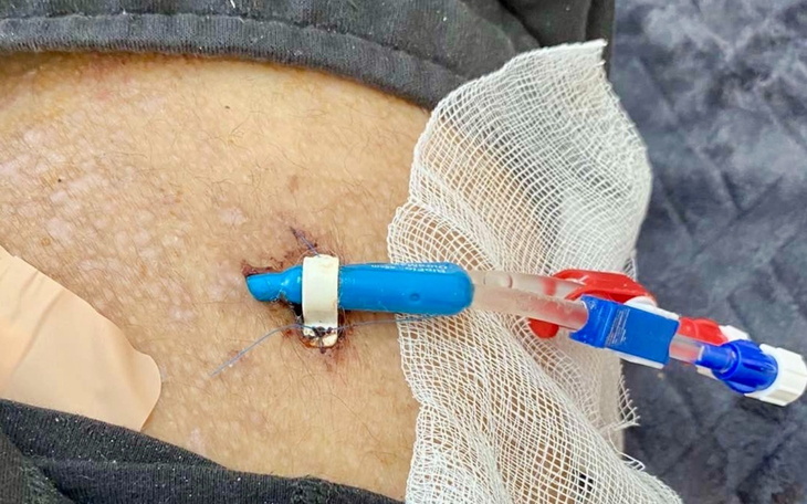 Zbliżenie na igłę włożoną w skórę pacjenta.