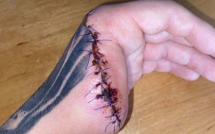 Zbiórka Na protezę kciuka i jego leczeni - zdjęcie główne