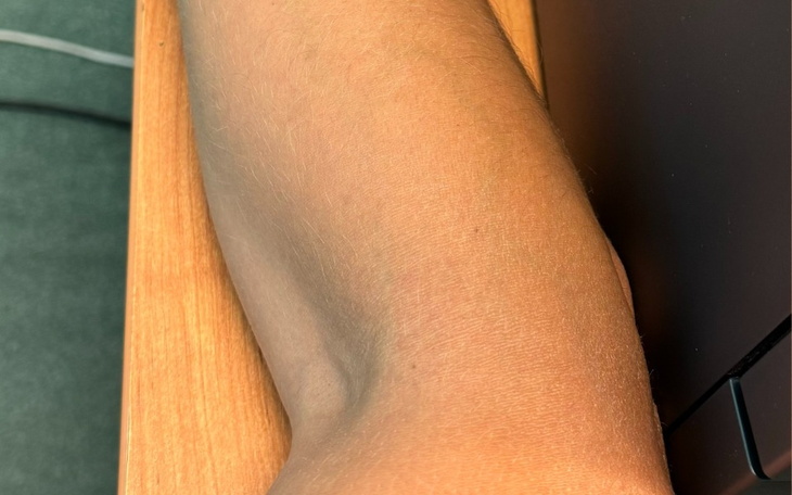 Zbiórka Operacja i rehabilitacja łokcia - zdjęcie główne