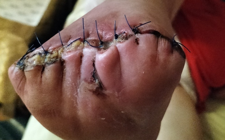 Zbiórka Zbiórka na buta po amputacji - zdjęcie główne